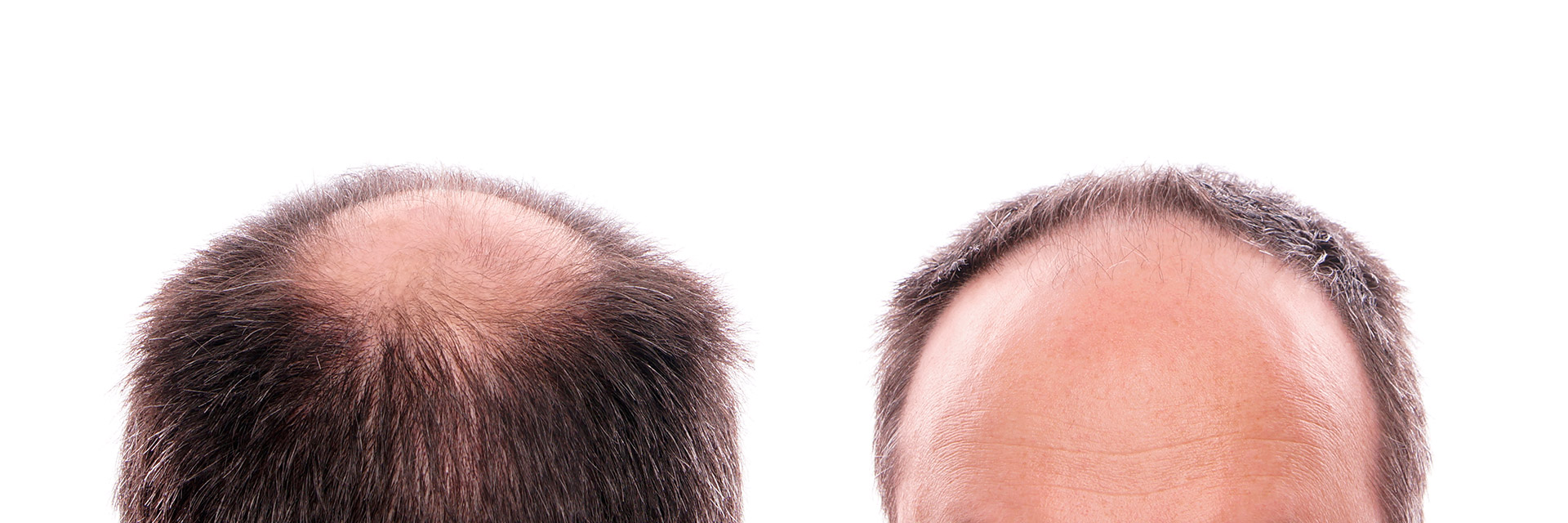Hair regrow bald areas