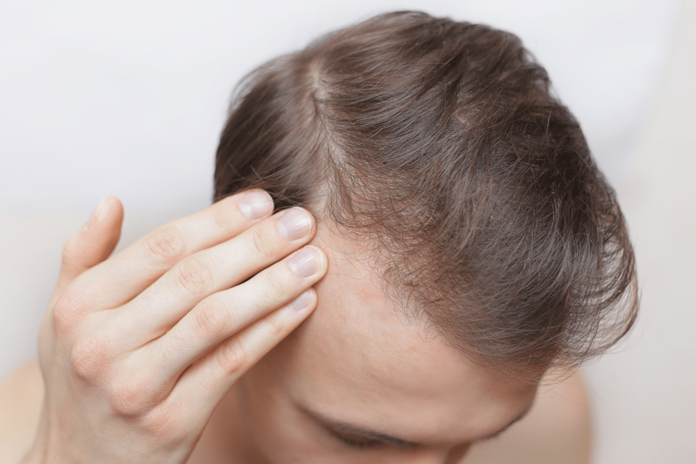 Hair Loss and ferritin deficiency