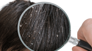 dandruff causes and prevention