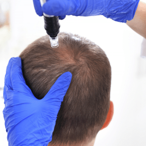 Microneedling hair loss
