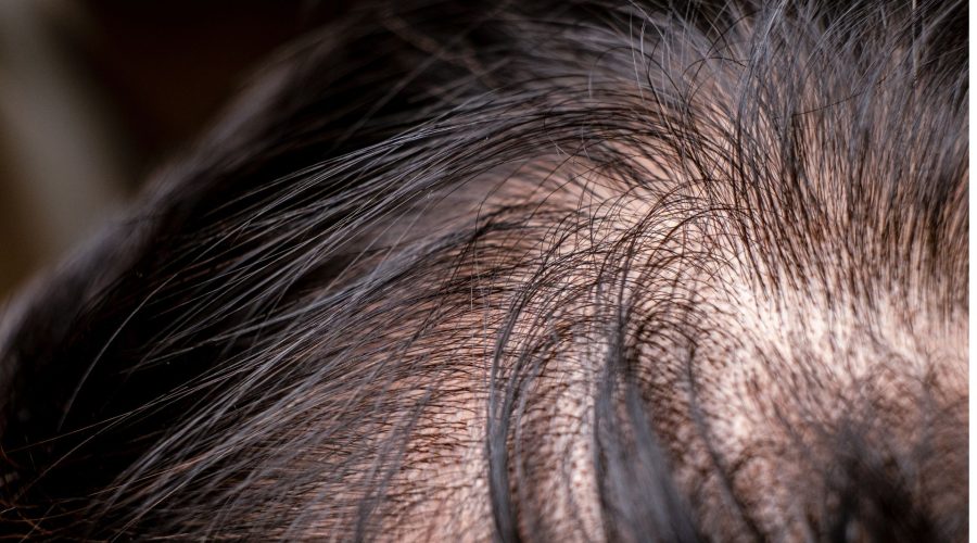 Is there a connection between allergies and hair loss?