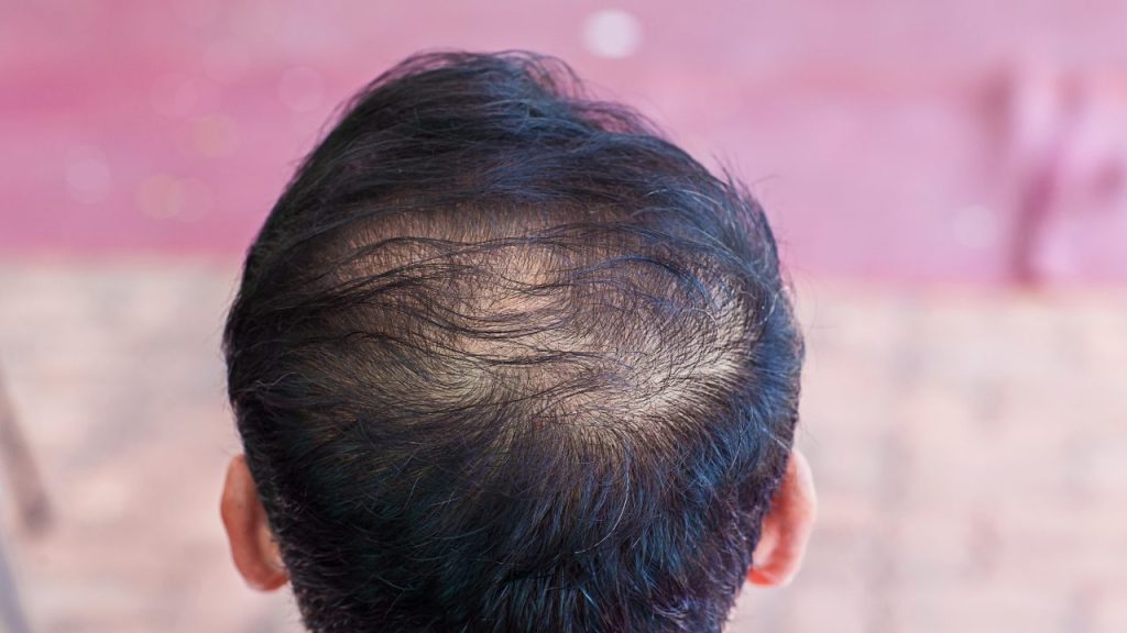 types of hair loss