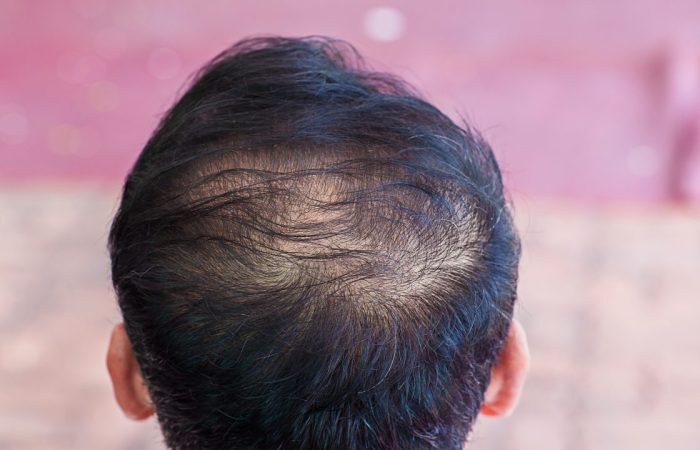 types of hair loss