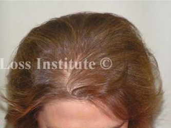 Effective natural hair loss treatment