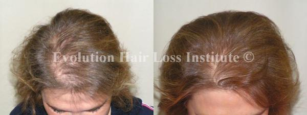 Effective natural hair loss treatment